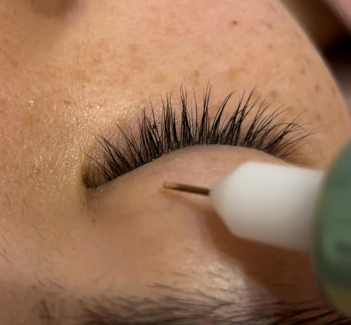 レーザーでは触れない目の周り、まぶたのシミも当店の低周波ペンシルで