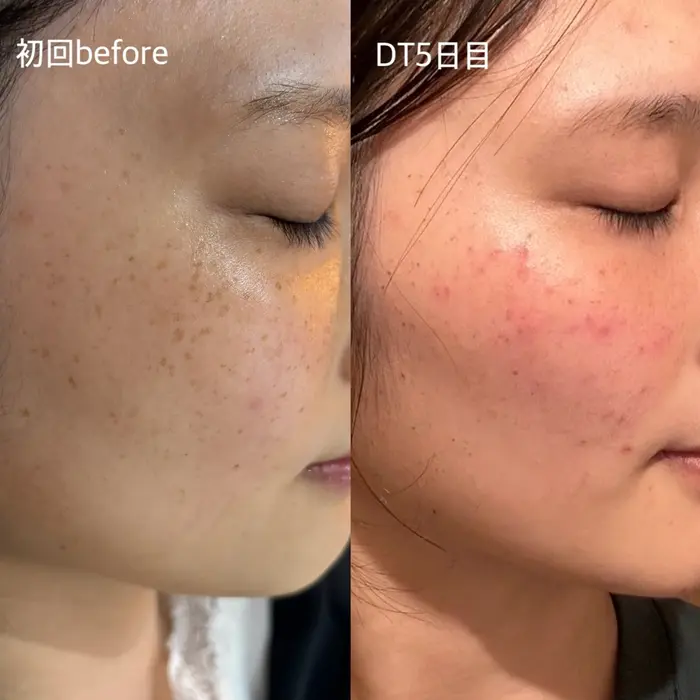 ↑↑一台で8役↑↑ハイドラフェイシャル、プラズマシャワー ハイドラフェイシャル プラズマシャワー エステ美容機器