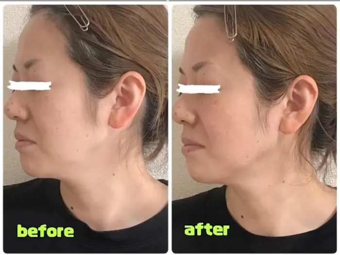 美顔器によってのビフォーアフターです フェイスラインがスッキリ｜鍵