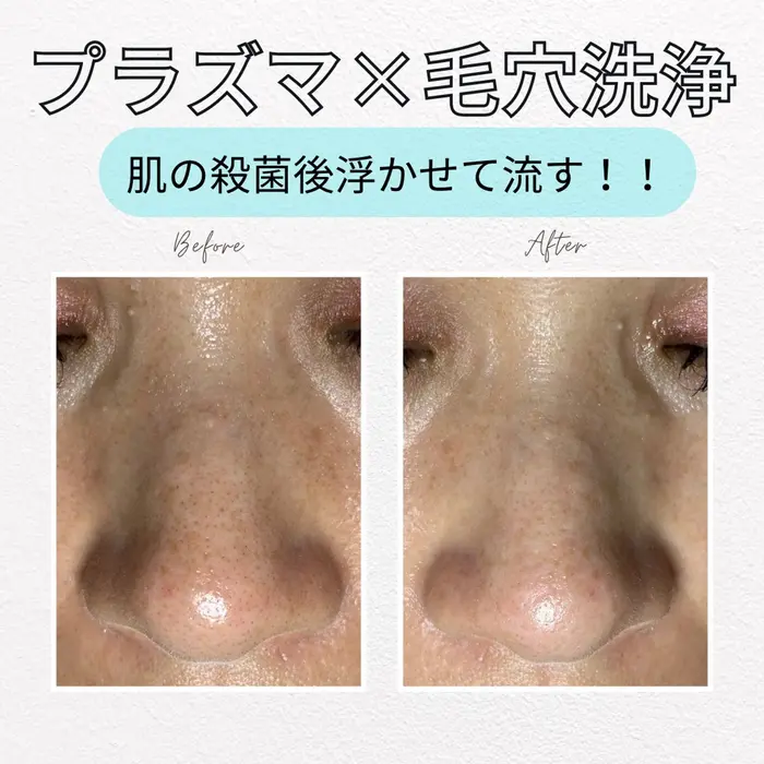 ハイドラフェイシャル　新品未使用　業務用　プラズマシャワー付き　毛穴洗浄 ハイドラフェイシャル 新品未使用 業務用 プラズマシャワー付き