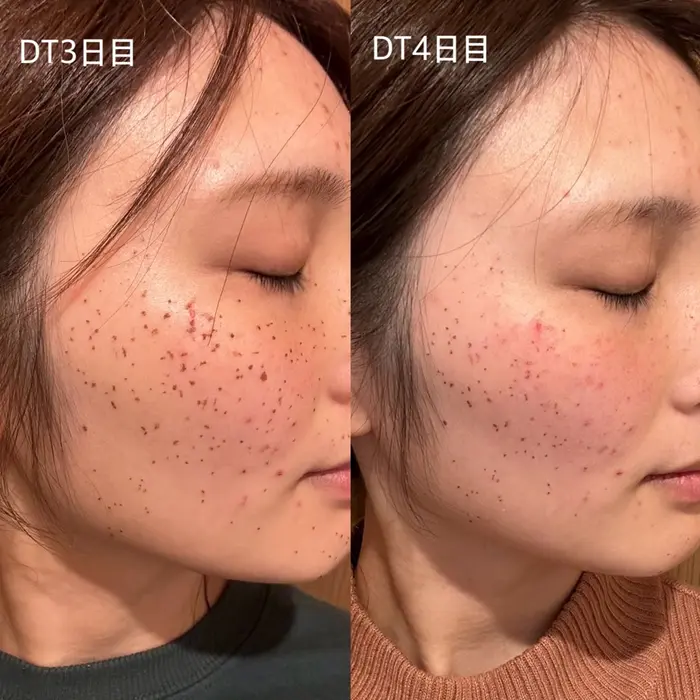 プラズマシャワー️×ハイドラフェイシャルで 毛穴の汚れがごっそり