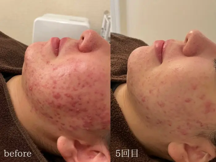 剥離ありハードハーブピーリング5回目｜美肌ケアサロン iru【アイル