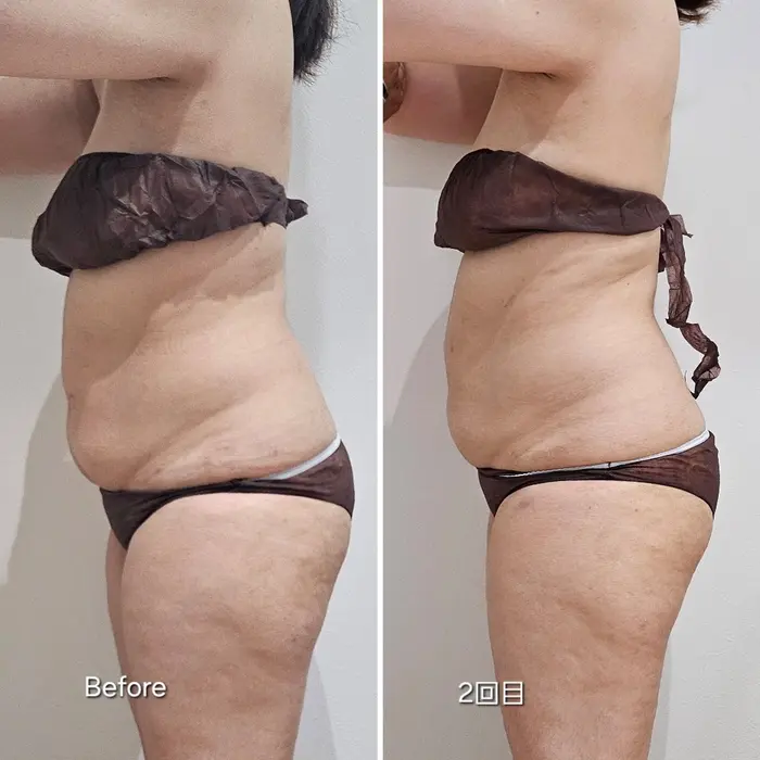 上下腹部2カップの Before→Afterのお写真です お腹の厚みが減ったの
