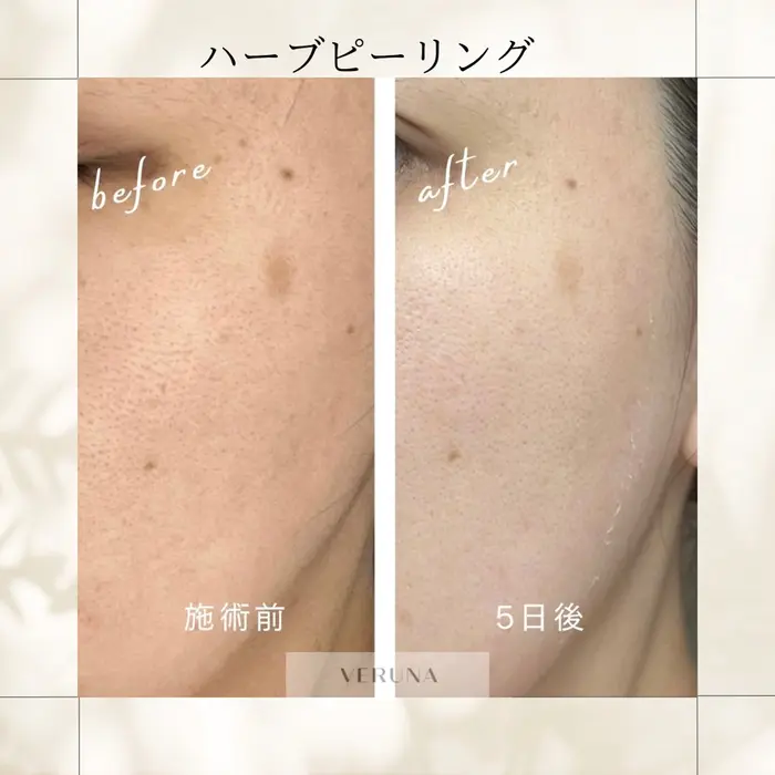 剥離なしハーブピーリング #剥離ありハーブピーリング #ハーブ