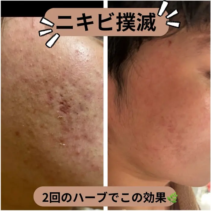 アネラセカンドです♪ お客様の剥離ありのハーブピーリングの経過です