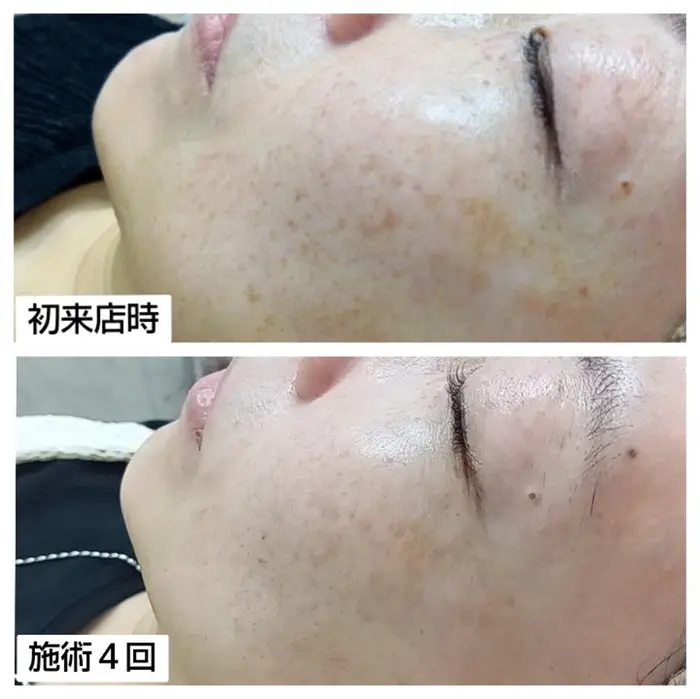 低周波でシミを排出していきます 痛みはほとんどありません｜シミケア