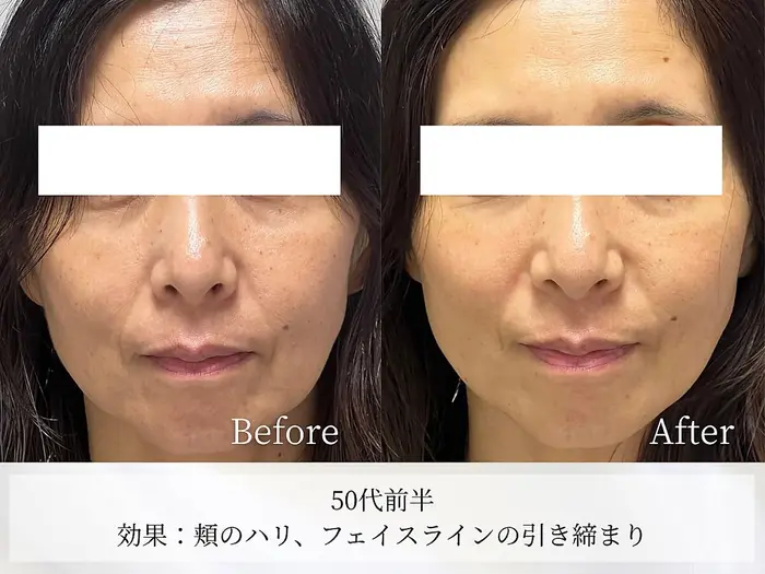 XE LHAピール セラピールとはララピールの特許成分を開発したDr.JCOSが