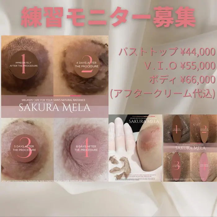SAKURAMELA】サクラメラメラニン施術 ・ローマピングなど、メラニン