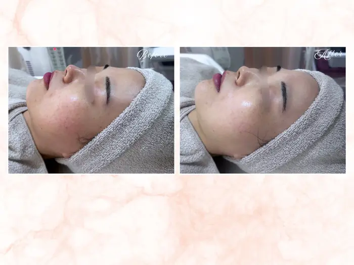 ピーリング・毛穴| soina神楽坂(s o i n aララピール／毛穴／小顔／水