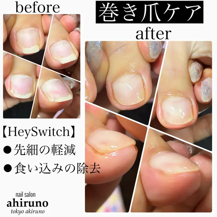 巻き爪ケア　巻き爪ジェル　ヘイスイッチ　HeySwitch ベース&トップ　新品 巻き爪ケア 巻き爪ジェル ヘイスイッチ HeySwitch ベース&トップ