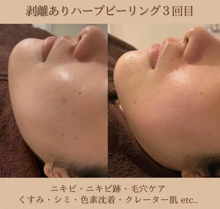 剥離ありハーブピーリング3回目 ニキビ跡が薄くなってきました
