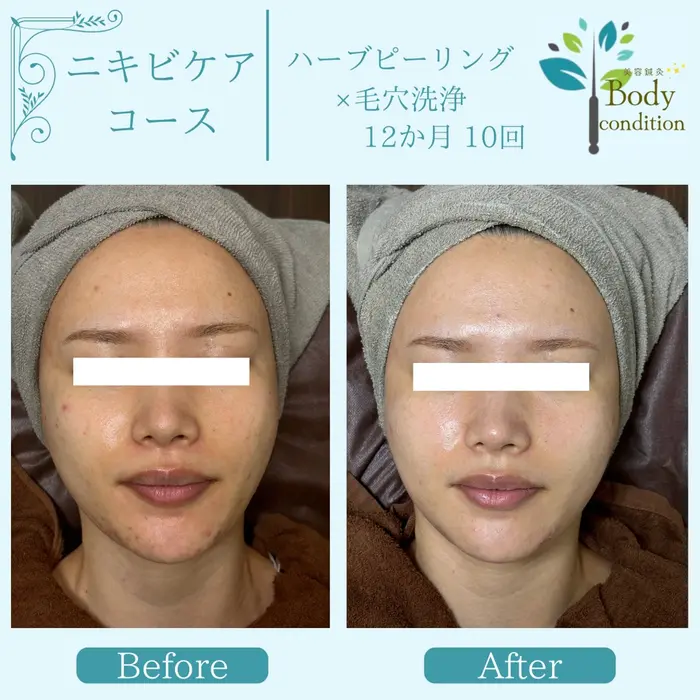 ラミネーションピール 10回分 ラミネーションピール/10回分/ラミピール/剥けないピーリング