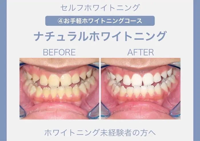 自然な白さのセルフホワイトニング｜ホワイトニング ビューティ名古屋