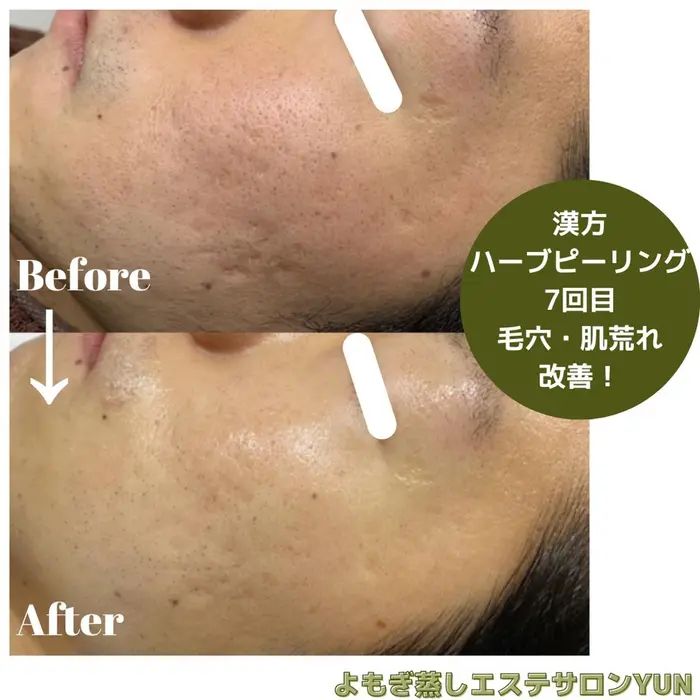 当店のハーブピーリング7回目のお客様 Before&After 毛穴の開き