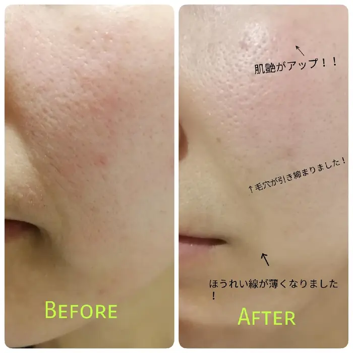 ハーブピーリングの効果 肌艶が格段にアップ！！ 毛穴のたるみに効果的