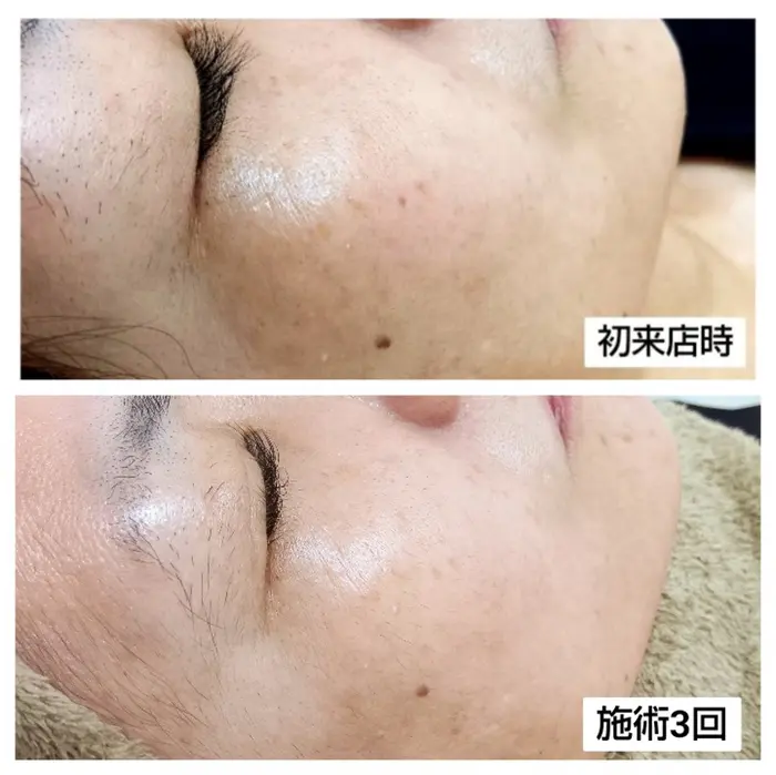 低周波でシミを排出していきます 痛みはほとんどありません
