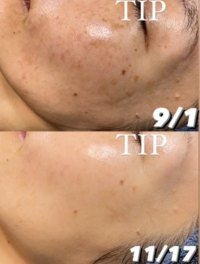 肌質改善エステサロン♡ 佐賀市💎フェイシャル/痩身/脱毛 男女エステUniclear (@uni