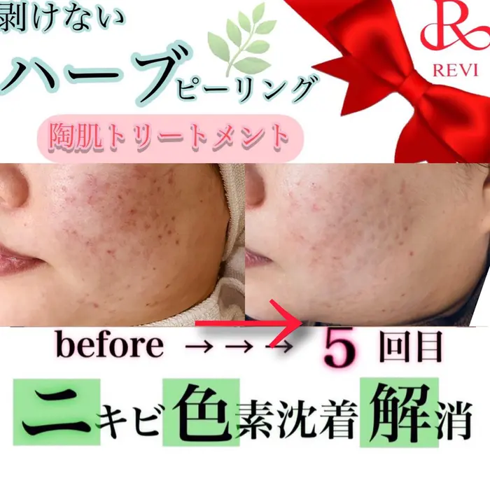 ニキビ、ニキビ痕ともに綺麗になりました 最新REVI ハーブ
