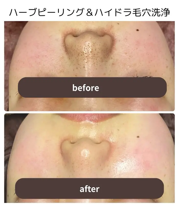 レーザーでは触れない目の周り、まぶたのシミも当店の低周波ペンシルで