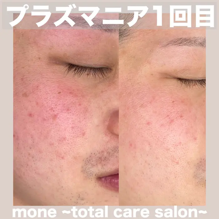 プラズマニア】【痛み・ダウンタイム無し】肝斑・くすみ・毛穴の