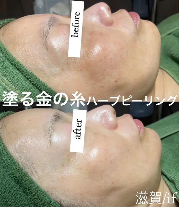 【本日限定セール‼️】onmyskin ハーブピーリング フェイシャル Lv.3 新品 未開封 オンマイスキン on myskin 顔用 ハーブピーリング