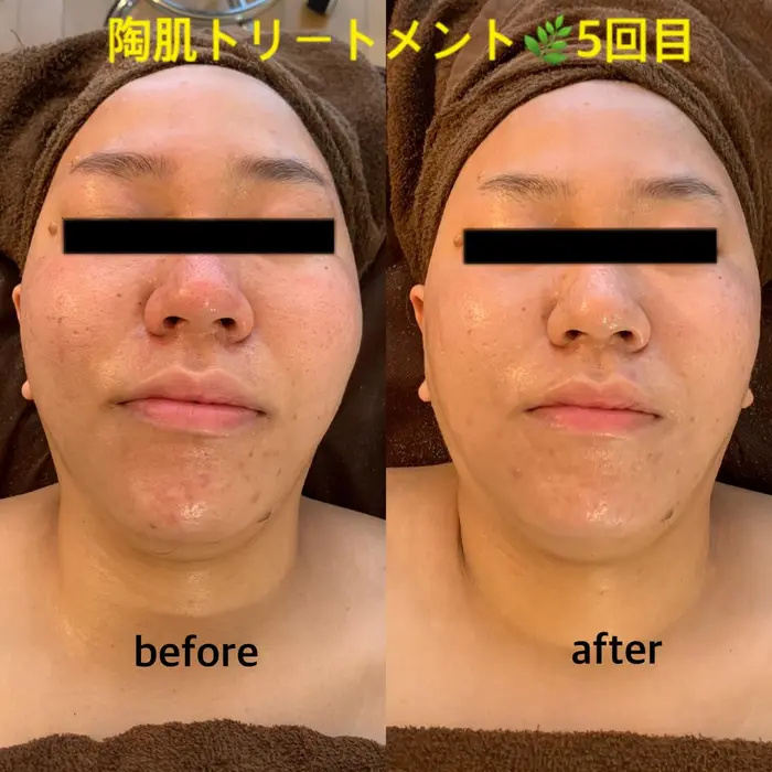 REVI 陶肌トリートメント(3回分) 回数券》陶肌トリートメント3回【お肌悩みに合わせた1種の