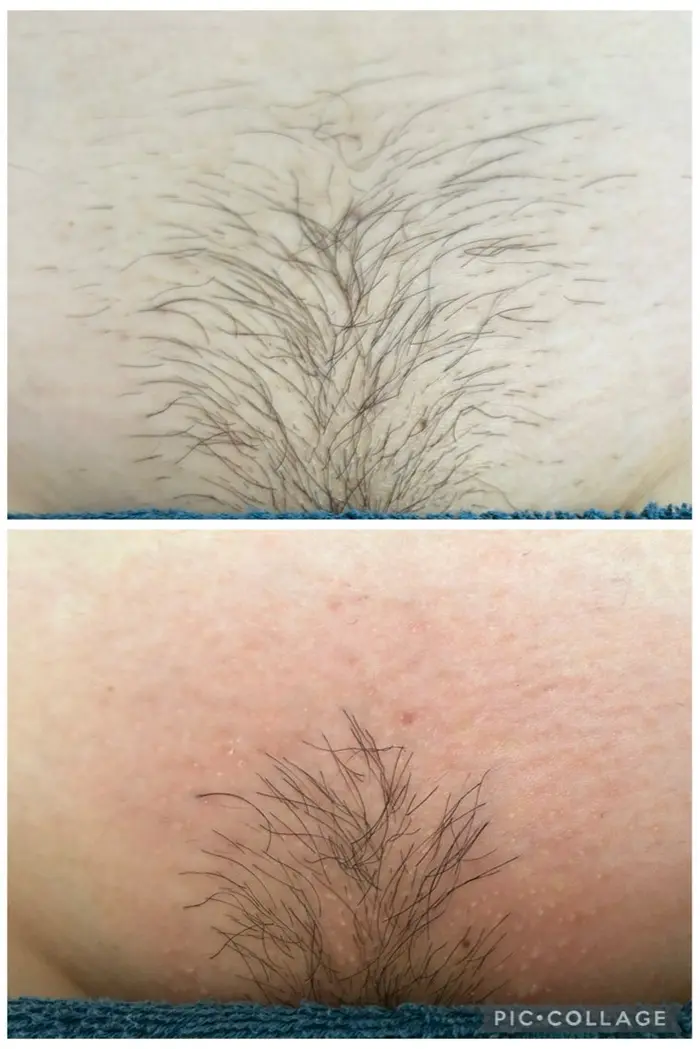 魔法の痩身ジェル＝針無し脂肪溶解ジェルはクリニックで大人気の脂肪