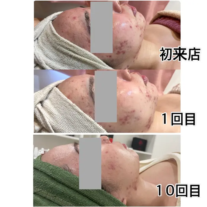 REVI ハーブピーリング　6回分 7回のREVIハーブピーリングでの変化◎ 色々試しても効果がなく