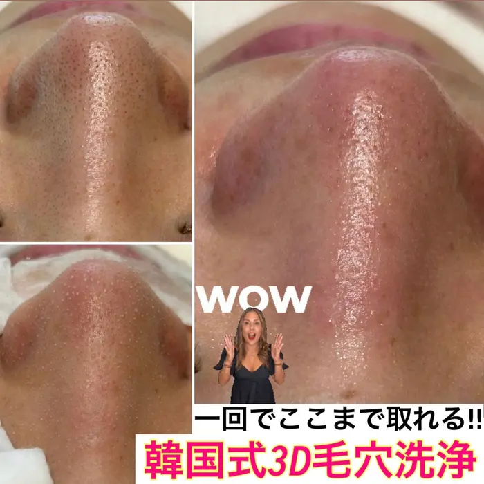 一回の施術でこんなにキレイに 『韓国式3D毛穴洗浄