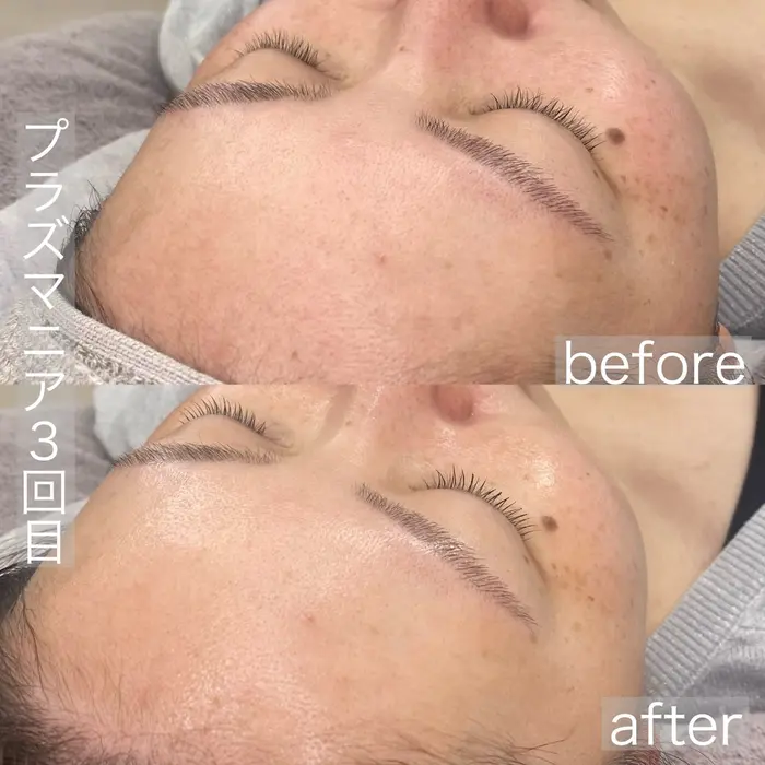 プラズマニア】【痛み・ダウンタイム無し】肝斑・くすみ・毛穴の