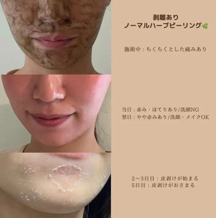 【JS♡】剥離ありハーブピーリング10回分 JS♡様専用】剥離ありハーブピーリング10回分