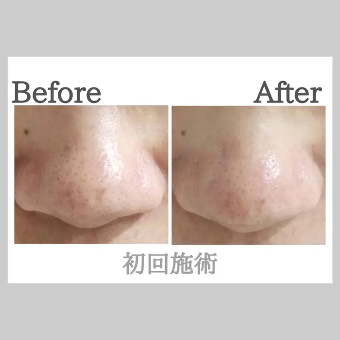 アクアピール（ハイドラフェイシャル） 韓国でも人気の肌に優しいピーリング（アクアピール/ハイドラ