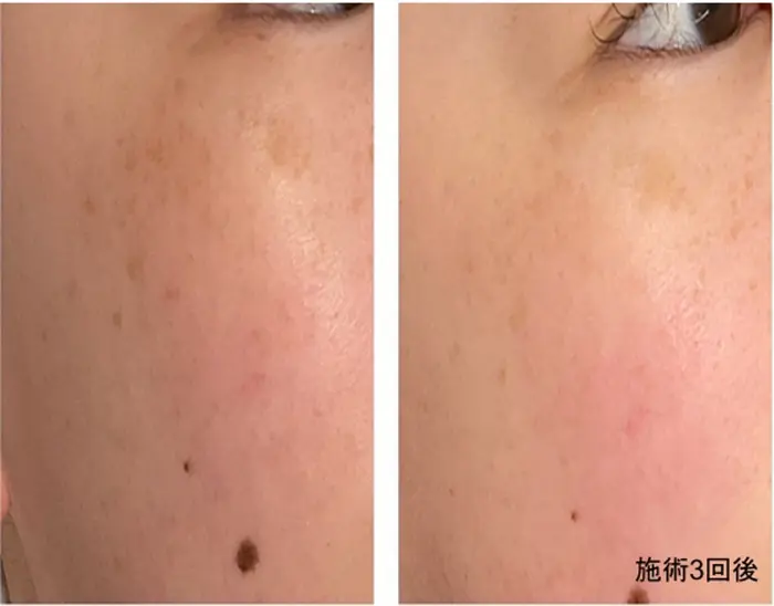 低周波でシミを排出していきます 痛みはほとんどありません