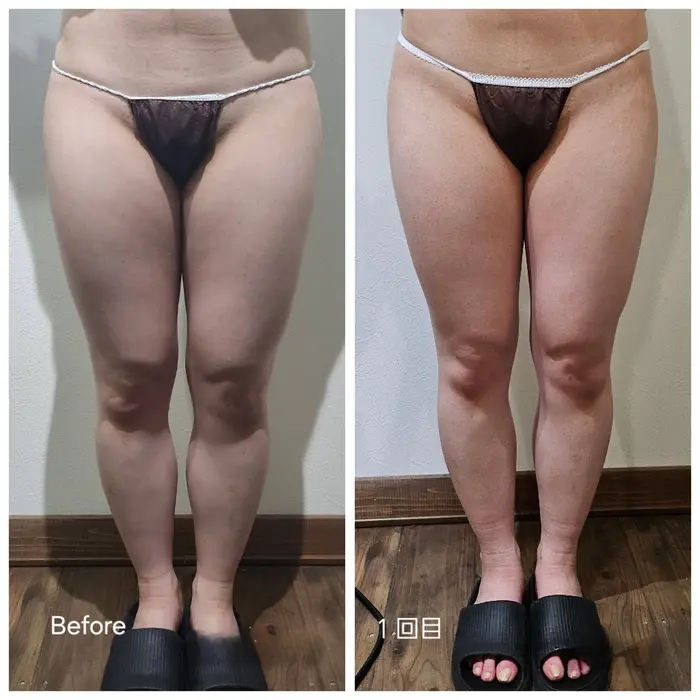 上下腹部2カップの Before→Afterのお写真です お腹の厚みが