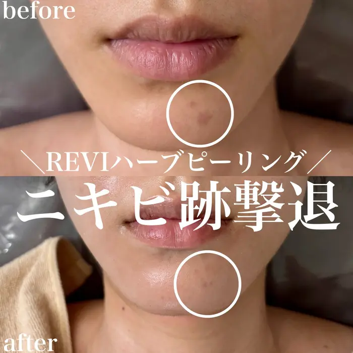 REVIハーブピーリングを4回受けていただいた方のお肌です