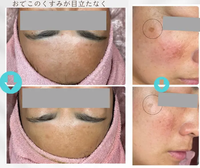 レーザーでは触れない目の周り、まぶたのシミも当店の低周波