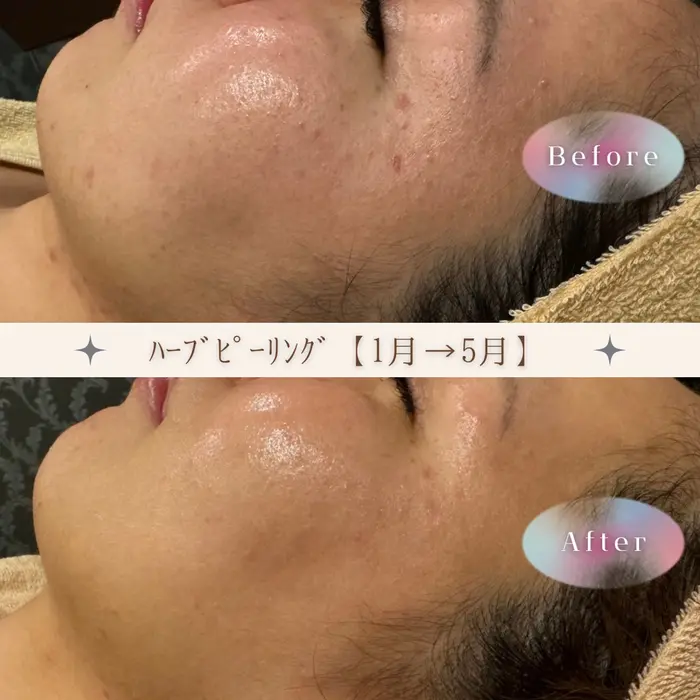 ハーブピーリング5回行った方のBefore Afterです！｜エステ