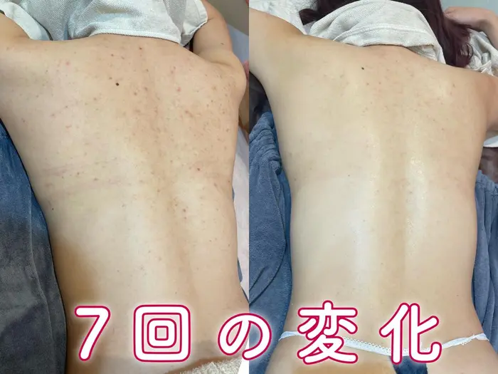 REVI ハーブピーリング　6回分 7回のREVIハーブピーリングでの変化◎ 色々試しても効果がなく