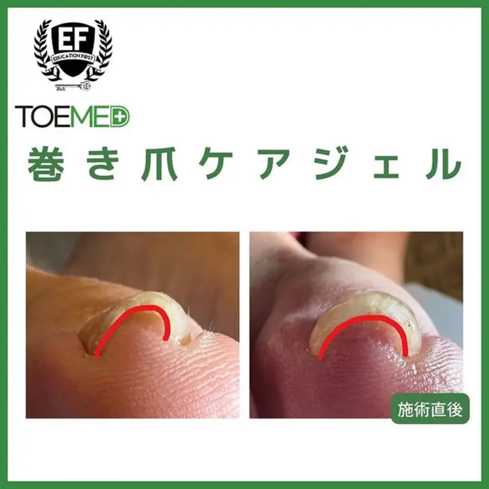 TOEMED 巻き爪ケアジェル 日本初上陸！！ 韓国医療で用いられる巻き爪ケアジェル【TOEMED