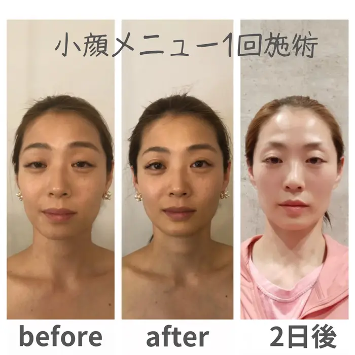 小顔メニュー ボディ全身とお顔のラジオ波××小顔矯正×最先端