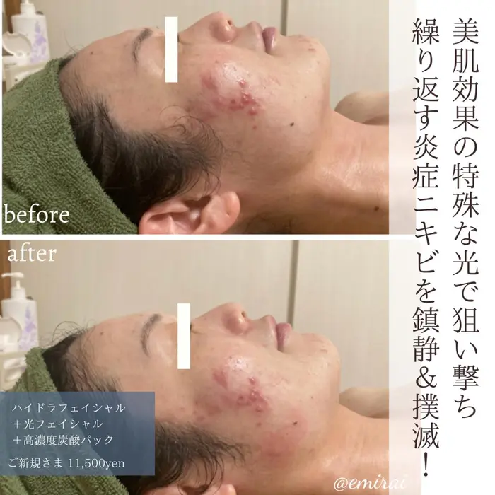 ハイドラフェイシャルで 余分なお顔の汚れを落とし、 光