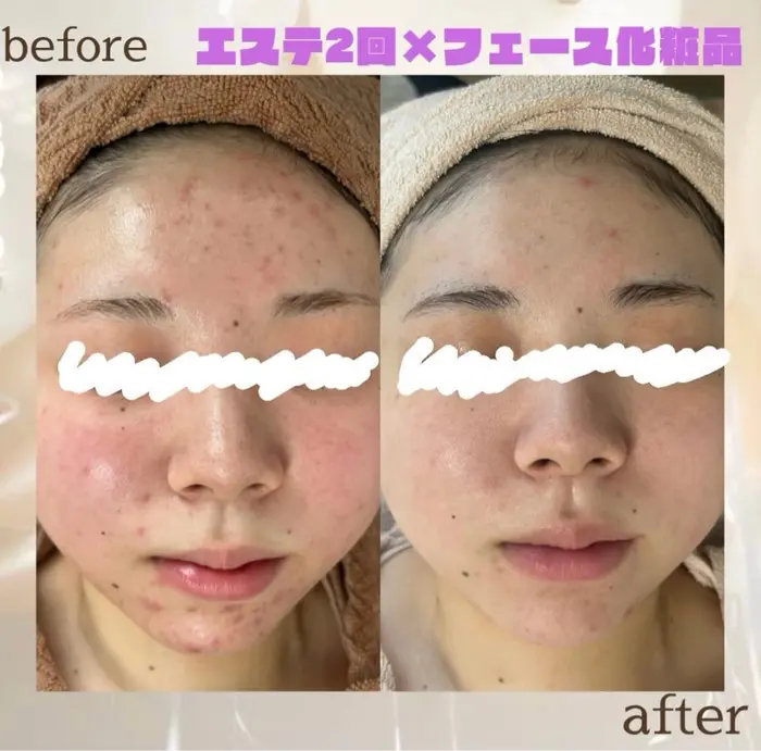 都度払い肌改善専門店 店長二上文香(aesthetic lighttree所属)のエステ