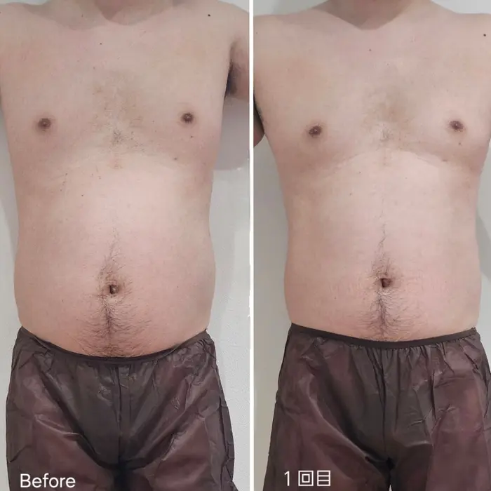 お腹周り脂肪冷却 Before→After（1回目）です(*^^*) お腹周りが全体