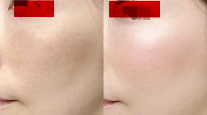 プラズマニードルカリファ世界初のマシーンで肌表面だけでなく真皮から