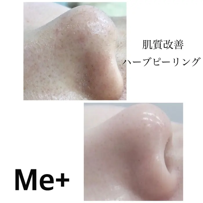 大人気ハーブピーリング 剥離なし、赤みなし、痛みなし