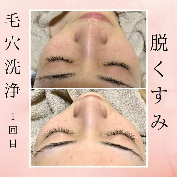 リラクゼーションエステサロン肌質改善イアリイ所属・肌質再生