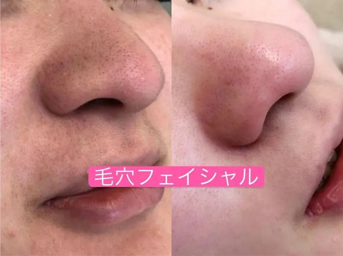 ハイドラフェイシャルで一回でも、毛穴の汚れをきれいに取れますよ