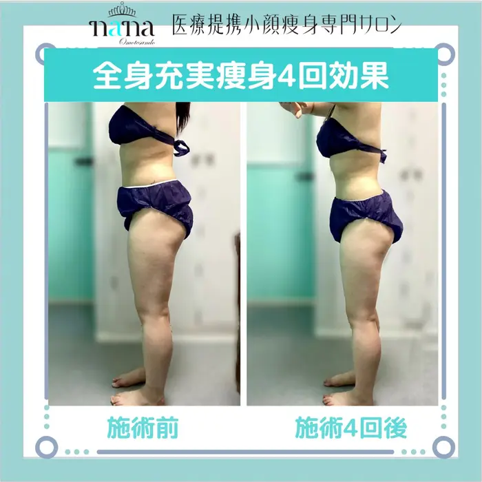 【N3月ご購入予定】キャビテーション エステ 痩身 Dr.Witch キャビテーション ラジオ波 エステ 痩身