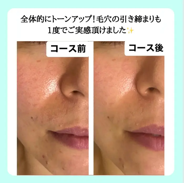 ハイドラフェイシャルは毛穴洗浄だけでなく 保湿、毛穴の引き締め