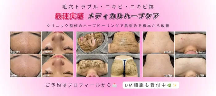 ハーブピーリングbeauty page1 南船場ハーブピーリング【beauty salon 222】所属・田中 有希菜